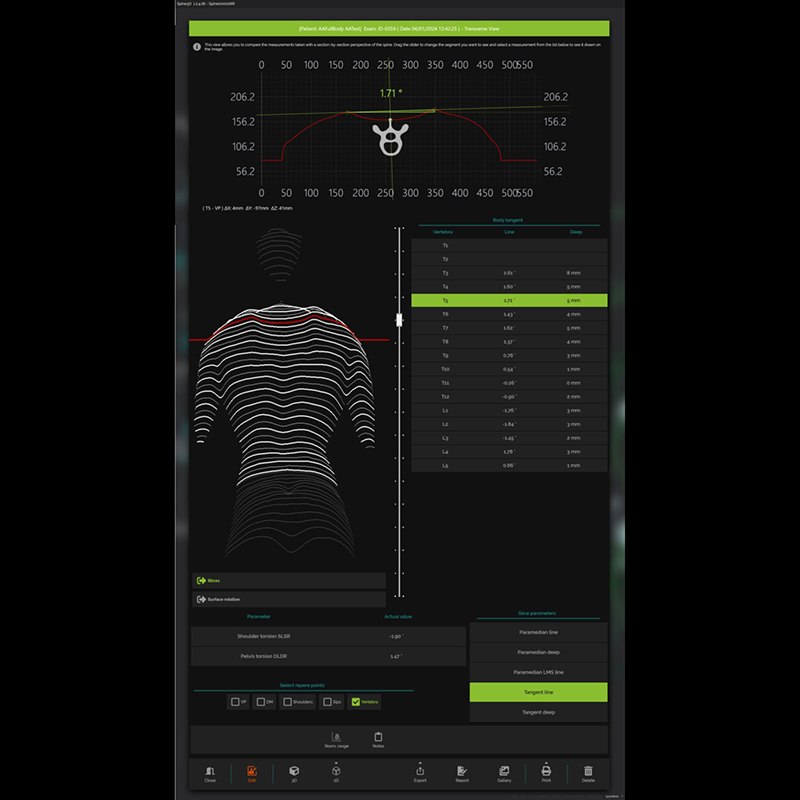 Система трёхмерного сканирования позвоночника Spine3D